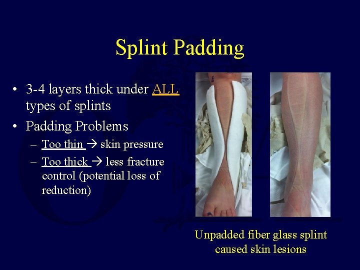 Splint Padding • 3 -4 layers thick under ALL types of splints • Padding Splint Padding • 3 -4 layers thick under ALL types of splints • Padding