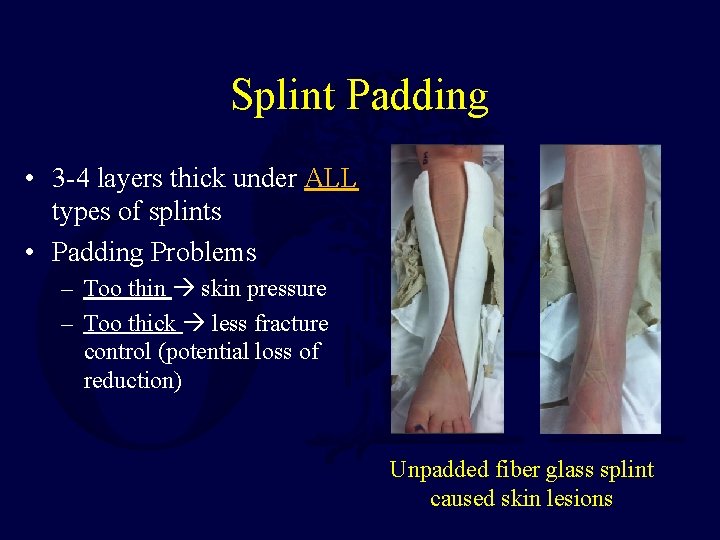 Splint Padding • 3 -4 layers thick under ALL types of splints • Padding