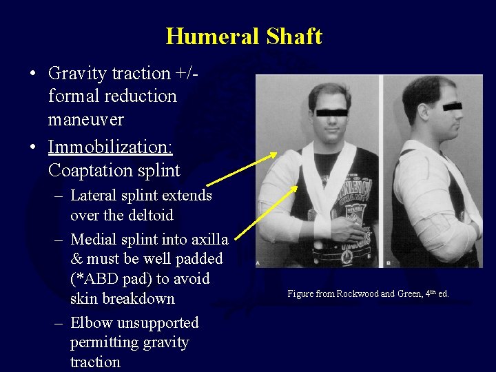Humeral Shaft • Gravity traction +/formal reduction maneuver • Immobilization: Coaptation splint – Lateral