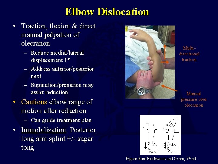 Elbow Dislocation • Traction, flexion & direct manual palpation of olecranon – Reduce medial/lateral Elbow Dislocation • Traction, flexion & direct manual palpation of olecranon – Reduce medial/lateral