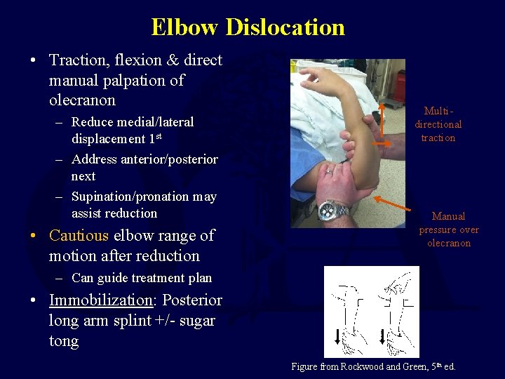 Elbow Dislocation • Traction, flexion & direct manual palpation of olecranon – Reduce medial/lateral