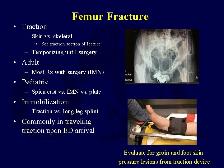  • Traction Femur Fracture – Skin vs. skeletal • See traction section of