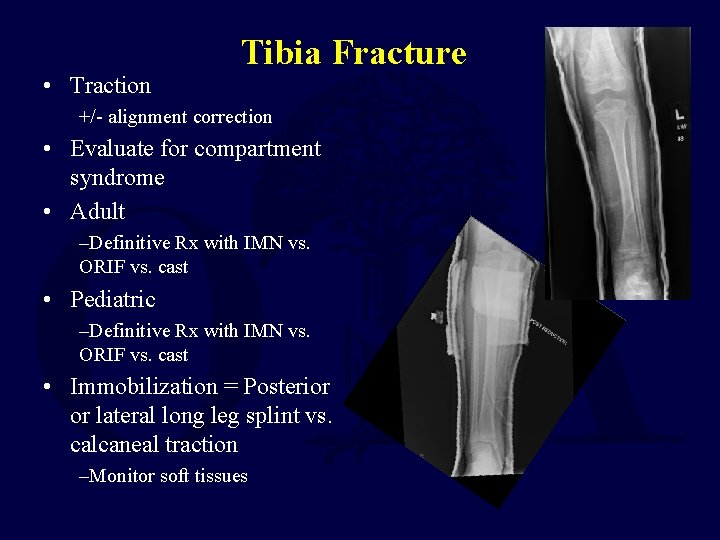 • Traction Tibia Fracture +/- alignment correction • Evaluate for compartment syndrome • • Traction Tibia Fracture +/- alignment correction • Evaluate for compartment syndrome •