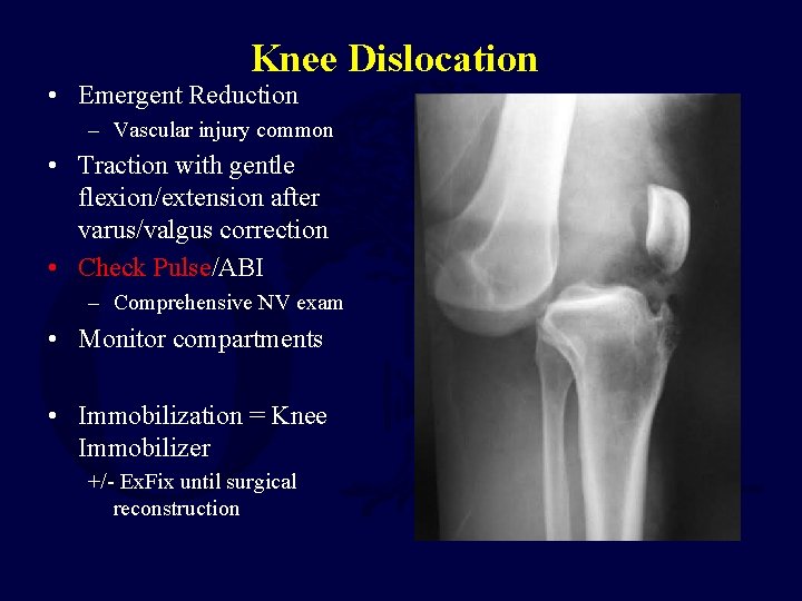 Knee Dislocation • Emergent Reduction – Vascular injury common • Traction with gentle flexion/extension Knee Dislocation • Emergent Reduction – Vascular injury common • Traction with gentle flexion/extension