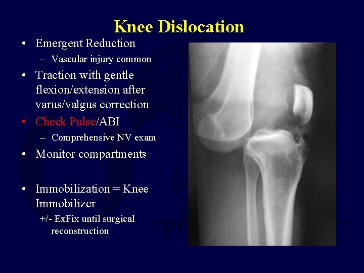 Knee Dislocation • Emergent Reduction – Vascular injury common • Traction with gentle flexion/extension