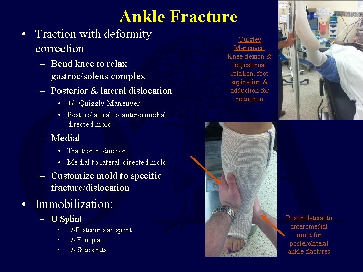 Ankle Fracture • Traction with deformity correction – Bend knee to relax gastroc/soleus complex Ankle Fracture • Traction with deformity correction – Bend knee to relax gastroc/soleus complex