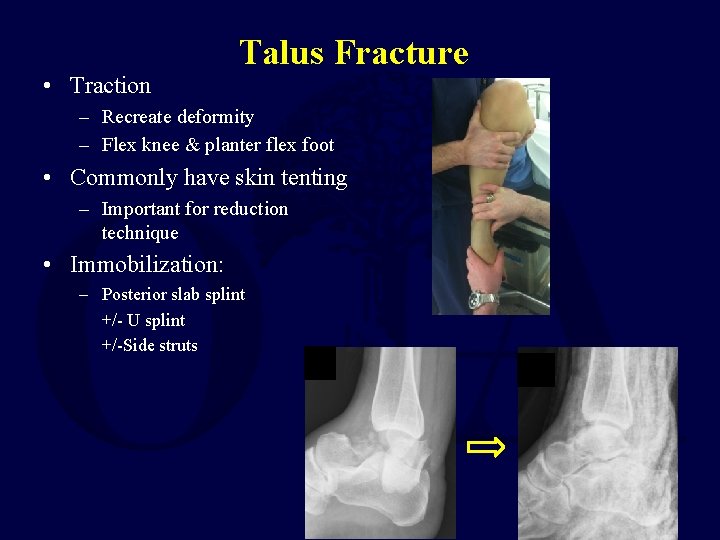 • Traction Talus Fracture – Recreate deformity – Flex knee & planter flex • Traction Talus Fracture – Recreate deformity – Flex knee & planter flex