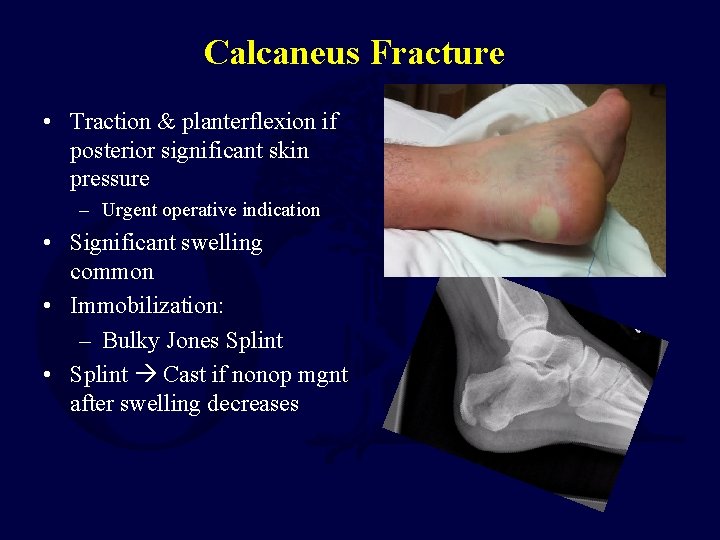Calcaneus Fracture • Traction & planterflexion if posterior significant skin pressure – Urgent operative Calcaneus Fracture • Traction & planterflexion if posterior significant skin pressure – Urgent operative