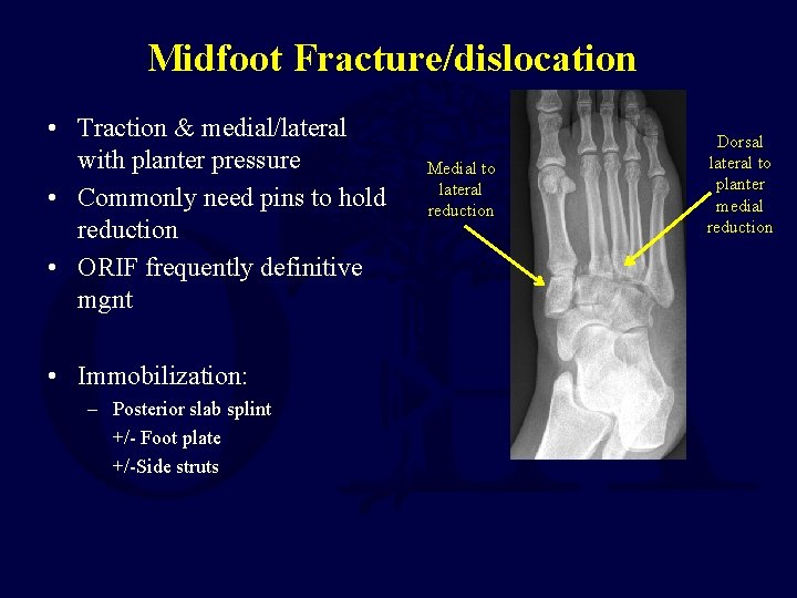 Midfoot Fracture/dislocation • Traction & medial/lateral with planter pressure • Commonly need pins to Midfoot Fracture/dislocation • Traction & medial/lateral with planter pressure • Commonly need pins to