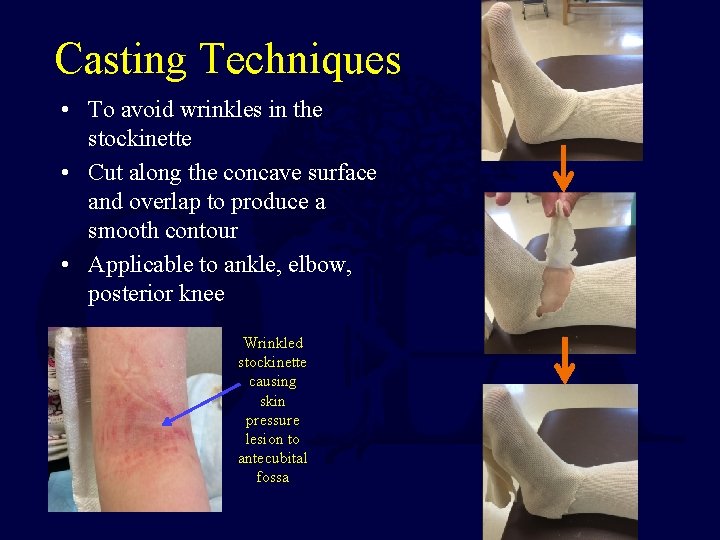 Casting Techniques • To avoid wrinkles in the stockinette • Cut along the concave Casting Techniques • To avoid wrinkles in the stockinette • Cut along the concave