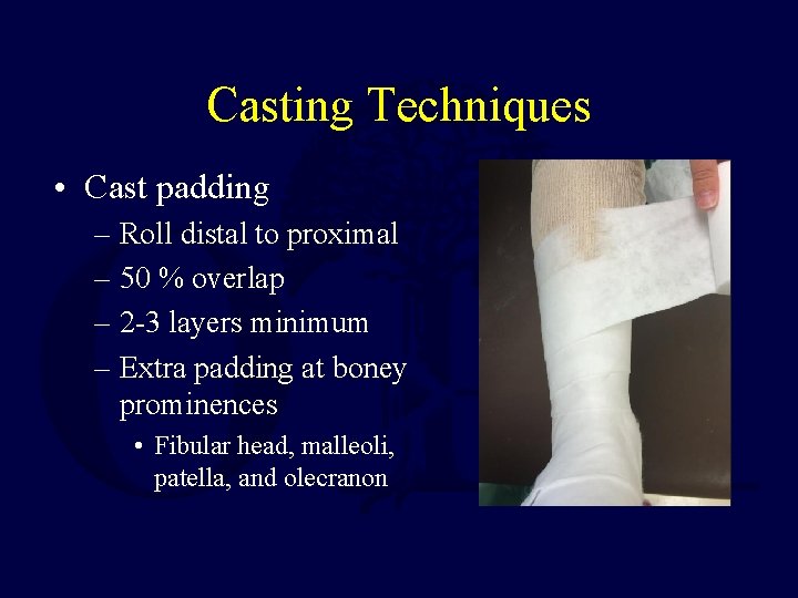 Casting Techniques • Cast padding – Roll distal to proximal – 50 % overlap Casting Techniques • Cast padding – Roll distal to proximal – 50 % overlap