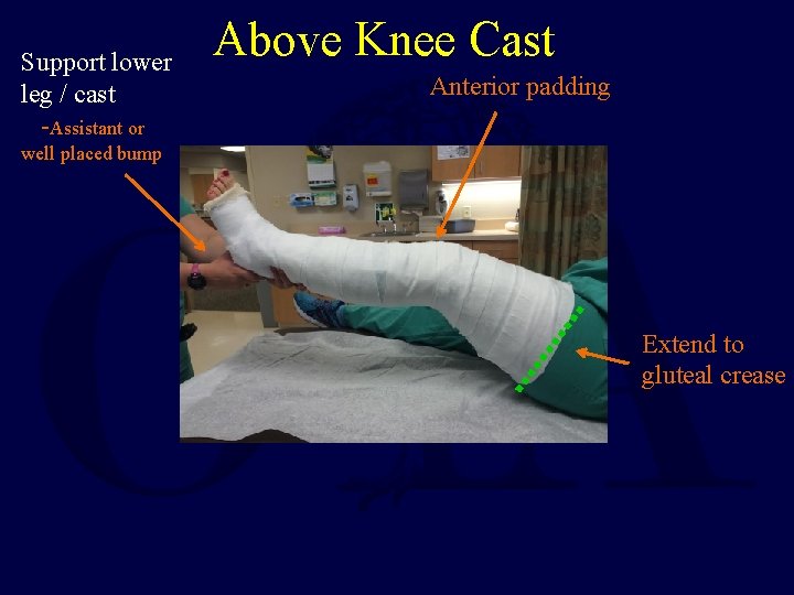 Support lower leg / cast -Assistant or Above Knee Cast Anterior padding well placed Support lower leg / cast -Assistant or Above Knee Cast Anterior padding well placed
