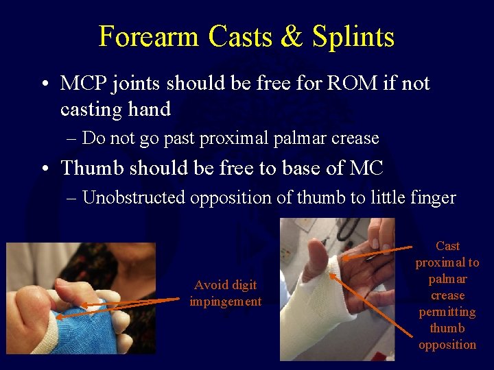 Forearm Casts & Splints • MCP joints should be free for ROM if not Forearm Casts & Splints • MCP joints should be free for ROM if not