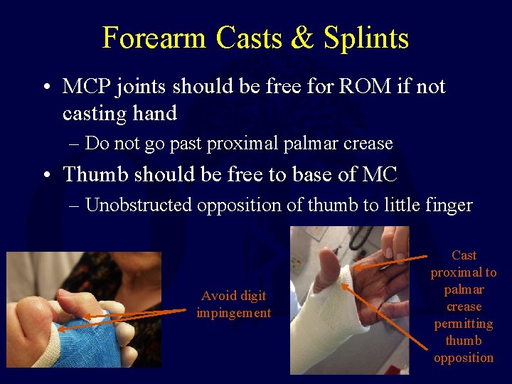 Forearm Casts & Splints • MCP joints should be free for ROM if not