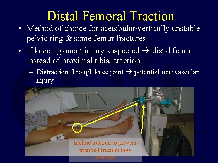 Distal Femoral Traction • Method of choice for acetabular/vertically unstable pelvic ring & some