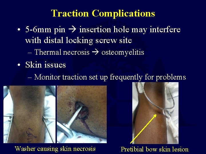 Traction Complications • 5 -6 mm pin insertion hole may interfere with distal locking
