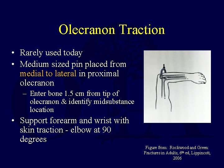 Olecranon Traction • Rarely used today • Medium sized pin placed from medial to Olecranon Traction • Rarely used today • Medium sized pin placed from medial to