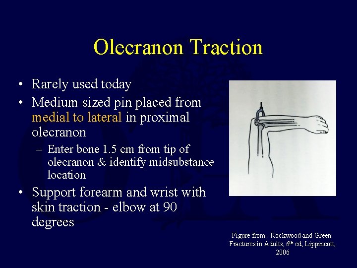 Olecranon Traction • Rarely used today • Medium sized pin placed from medial to