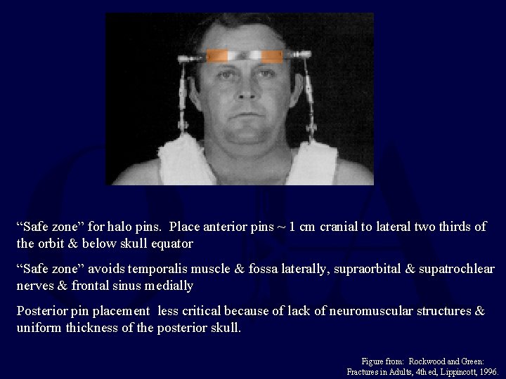 “Safe zone” for halo pins. Place anterior pins ~ 1 cm cranial to lateral “Safe zone” for halo pins. Place anterior pins ~ 1 cm cranial to lateral