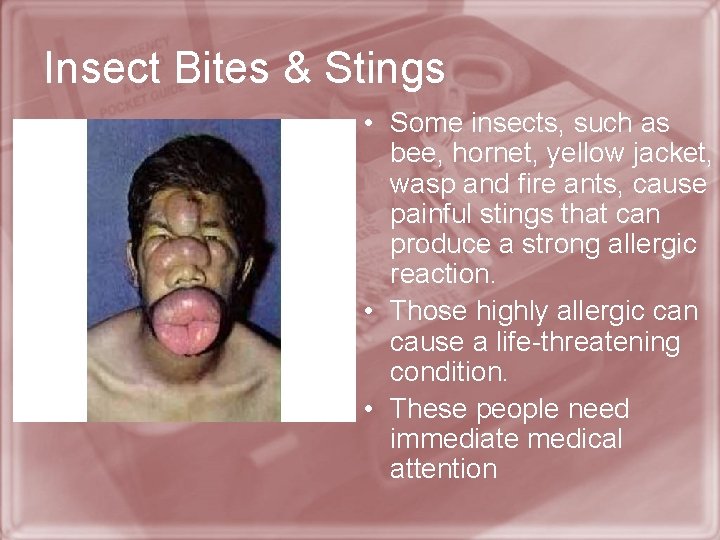 Insect Bites & Stings • Some insects, such as bee, hornet, yellow jacket, wasp