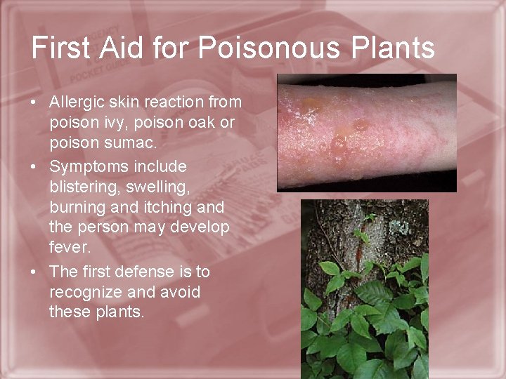 First Aid for Poisonous Plants • Allergic skin reaction from poison ivy, poison oak