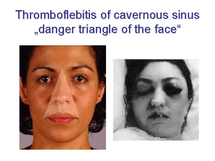 Thromboflebitis of cavernous sinus „danger triangle of the face“ 