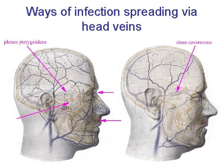 Ways of infection spreading via head veins 