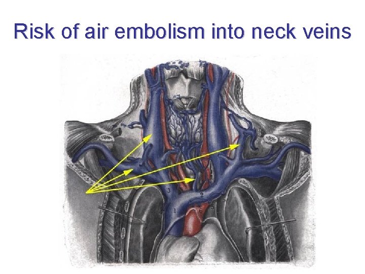 Risk of air embolism into neck veins 