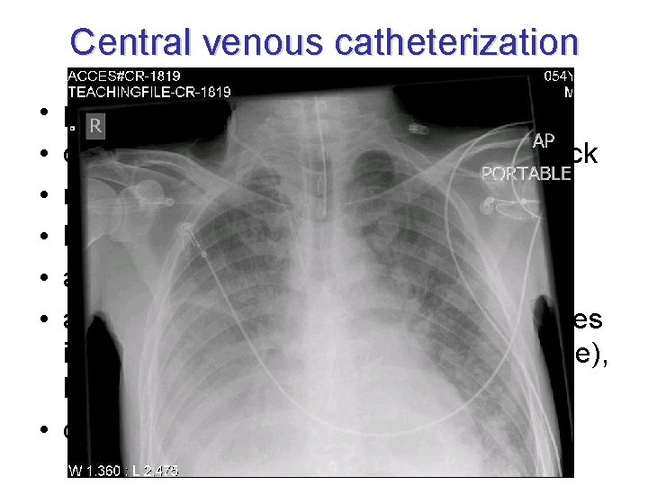 Central venous catheterization • • • permanent venous approach central veins do not collapse