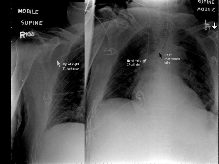 Wrong position of catheter Wrong position of catheter