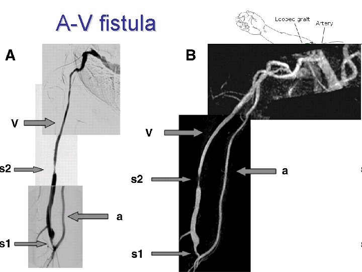 A-V fistula • • iatrogenous dialysis radiocephalic (ulnarocephalicc, brachiocephalic, brachiobasilic) • (LL: tibiosaphenous) • A-V fistula • • iatrogenous dialysis radiocephalic (ulnarocephalicc, brachiocephalic, brachiobasilic) • (LL: tibiosaphenous) •