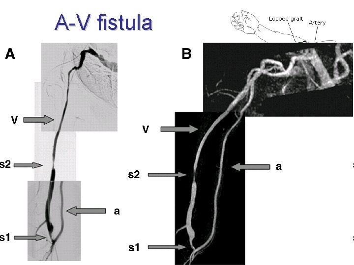 A-V fistula • • iatrogenous dialysis radiocephalic (ulnarocephalicc, brachiocephalic, brachiobasilic) • (LL: tibiosaphenous) •