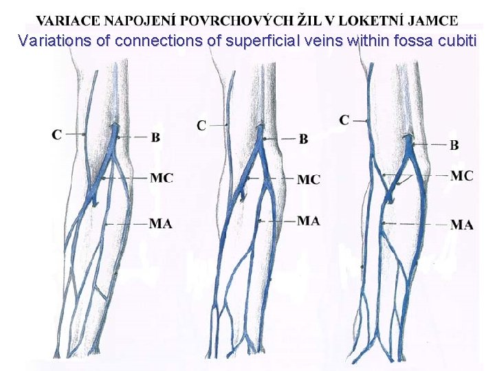 Variations of connections of superficial veins within fossa cubiti Variations of connections of superficial veins within fossa cubiti