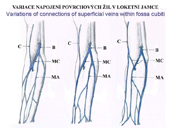 Variations of connections of superficial veins within fossa cubiti 