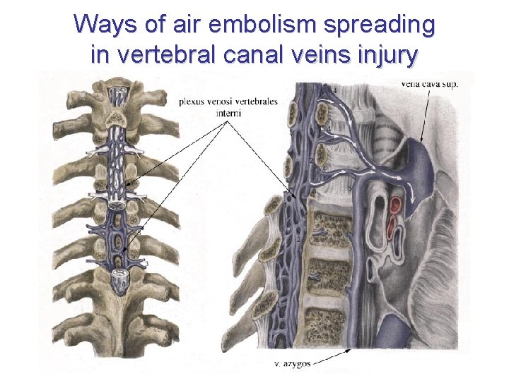 Ways of air embolism spreading in vertebral canal veins injury 