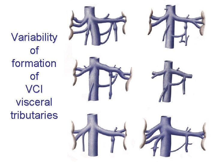 Variability of formation of VCI visceral tributaries Variability of formation of VCI visceral tributaries