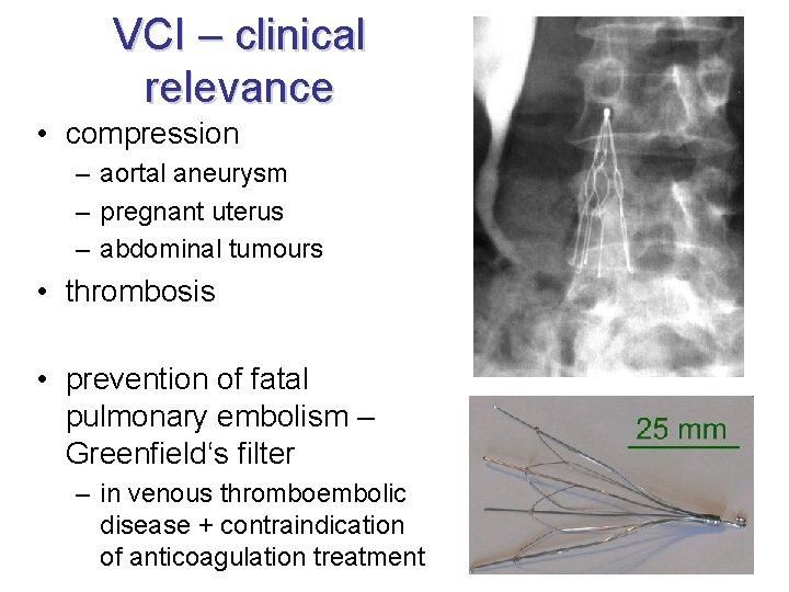 VCI – clinical relevance • compression – aortal aneurysm – pregnant uterus – abdominal