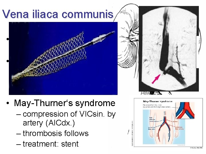 Vena iliaca communis • course corresponds to artery • tributaries: – v. lumbalis ascendens