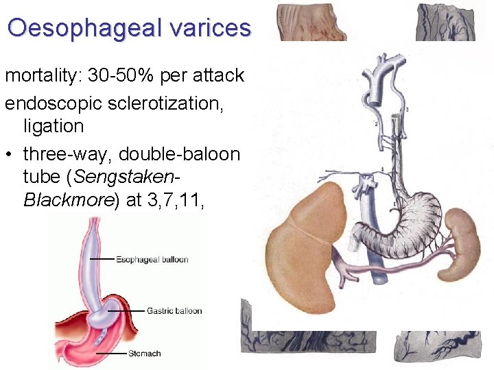 Oesophageal varices mortality: 30 -50% per attack endoscopic sclerotization, ligation • three-way, double-baloon tube