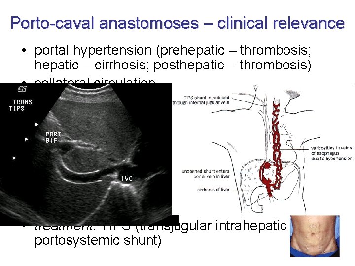 Porto-caval anastomoses – clinical relevance • portal hypertension (prehepatic – thrombosis; hepatic – cirrhosis;