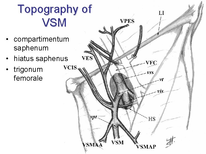 Topography of VSM • compartimentum saphenum • hiatus saphenus • trigonum femorale 