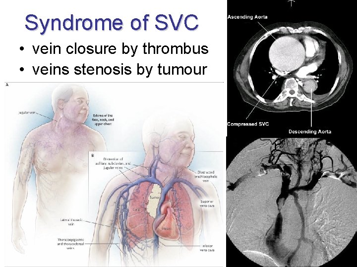 Syndrome of SVC • vein closure by thrombus • veins stenosis by tumour 