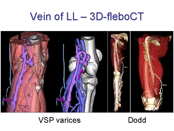 Vein of LL – 3 D-flebo. CT VSP varices Dodd 