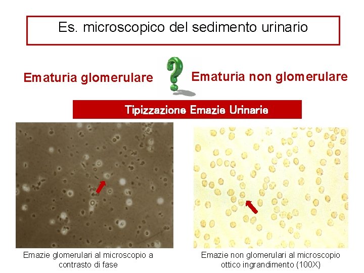 Es. microscopico del sedimento urinario Ematuria glomerulare Ematuria non glomerulare Tipizzazione Emazie Urinarie Emazie