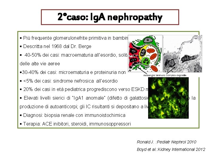 2°caso: Ig. A nephropathy § Più frequente glomerulonefrite primitiva in bambini ed adulti §