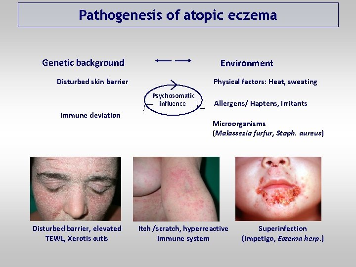 Pathogenesis of atopic eczema Genetic background Environment Disturbed skin barrier Physical factors: Heat, sweating