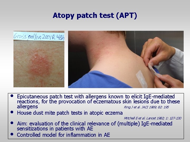 Atopy patch test (APT) • • Epicutaneous patch test with allergens known to elicit