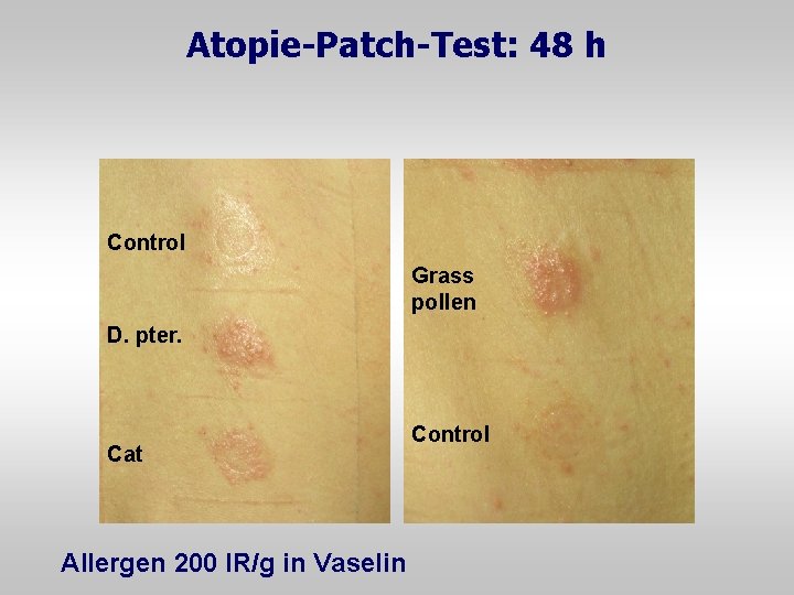 Atopie-Patch-Test: 48 h Control Grass pollen D. pter. Cat Allergen 200 IR/g in Vaselin