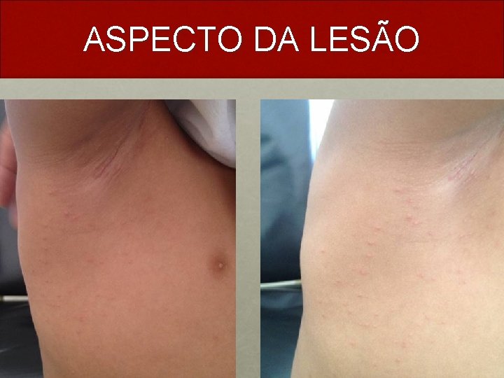 ASPECTO DA LESÃO 