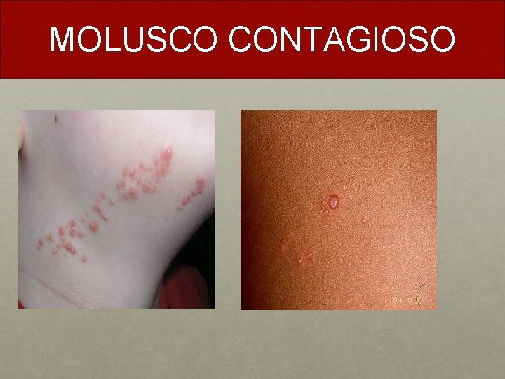 MOLUSCO CONTAGIOSO 